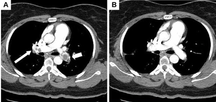 Image: (A) Helical CT angiogram showing emboli in bilateral pulmonary arteries with large thrombus in the left main pulmonary artery (short arrow) and multiple thrombi in the right main pulmonary artery (long arrow) prior to ultrasound-accelerated thrombolytic therapy. (B) Follow-up CT angiogram performed 5 days after successful thrombolytic therapy using the EkoSonic device, demonstrating complete resolution of bilateral pulmonary emboli (photo courtesy Peter Lin / Medscape General Surgery).